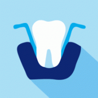Θεραπεία δοντιού με περιοδοντίτιδα